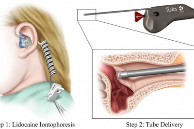 Ear Tube Devices Are Primarily Used To Treat Infections While Also Assisting In The Drainage Of Pus And Mucus Buildup Inside The Ear