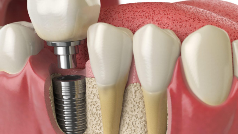Tips on how to Locate a Basic Dentist