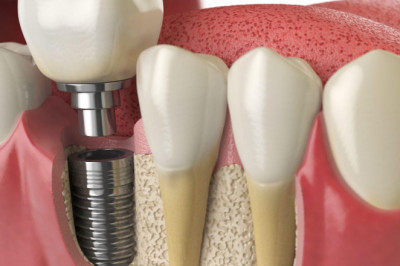 Tips on how to Locate a Basic Dentist