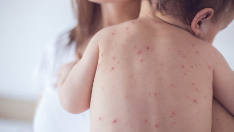 Acne Scar Therapies That Work