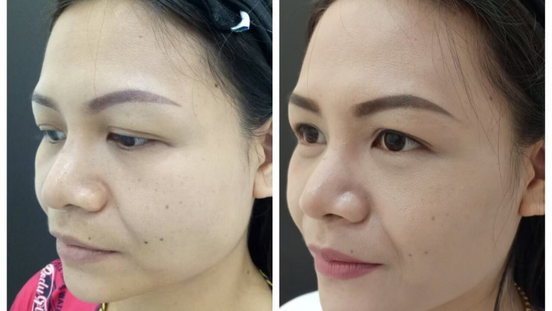 Botox Therapies - What To Anticipate