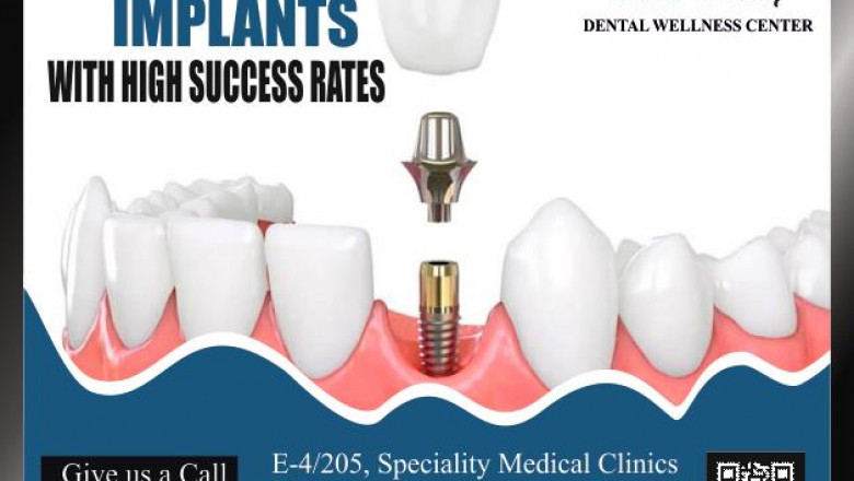 Dental Implant cost in Bhopal Best Dental Clinic In Bhopal