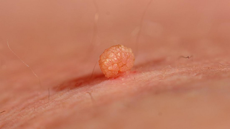 How to Do Anal Skin Tag Removal