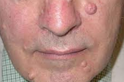 Neurofibromatosis is caused due to a genetic mutation, resulting in the formation of tumors in various parts of a body