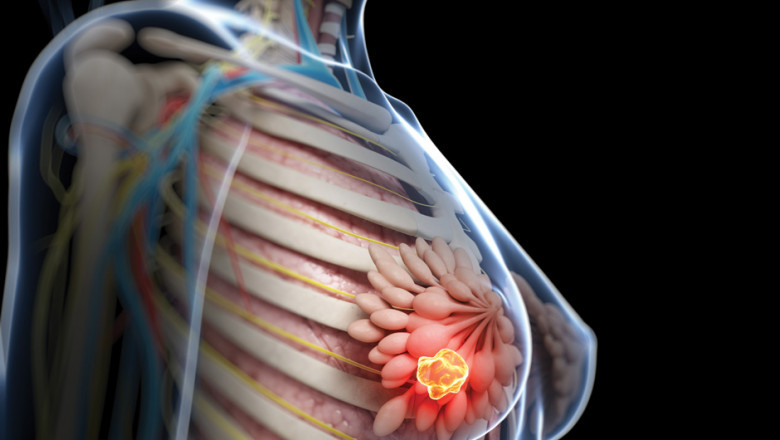 Breast Cancer Diagnostic and Drug Technologies
