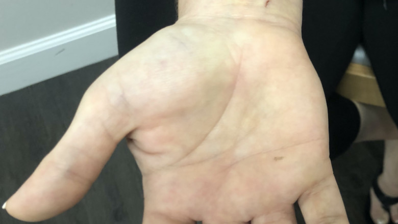 Find Carpal Tunnel Surgery Doctor near me