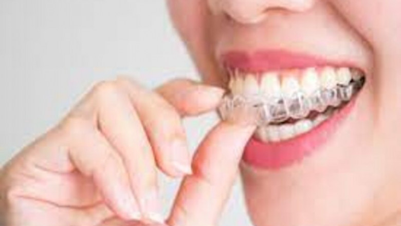 Invisalign Removal Tool With Dental Movemints