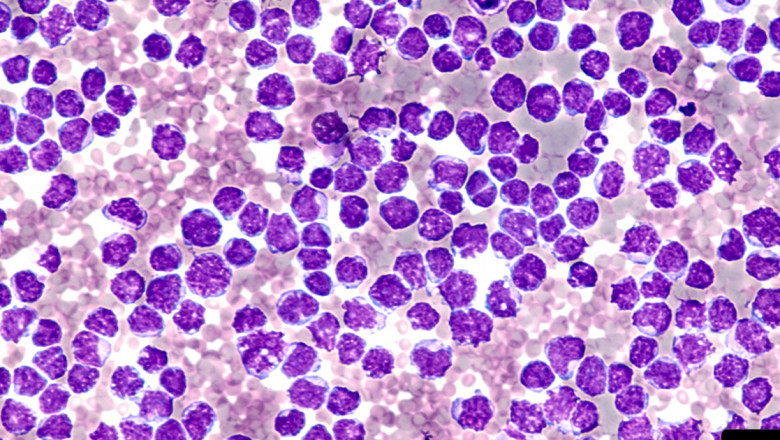 Mantle cell lymphoma is one of the B-cell Non-Hodgkin lymphomas, which occur as a result of the formation of tumours in the lymph nodes, enters the blood and spreads to the bone marrow and liver