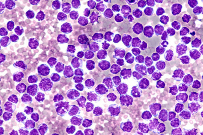Mantle cell lymphoma is one of the B-cell Non-Hodgkin lymphomas, which occur as a result of the formation of tumours in the lymph nodes, enters the blood and spreads to the bone marrow and liver