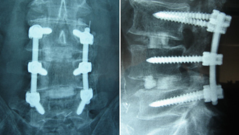 Spine fusion is a surgical procedure used to correct problems related to small bones in the spine