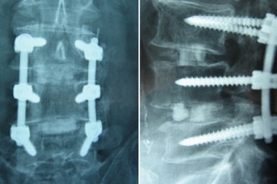 Spine fusion is a surgical procedure used to correct problems related to small bones in the spine