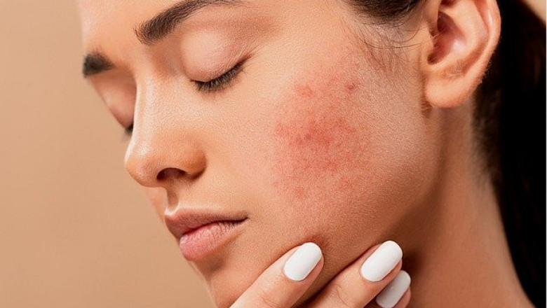 Acne Diet Plan Get Rid of Acne by Eating Healthier