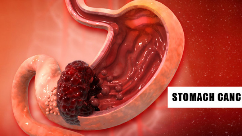 Stomach/Gastric Cancer Treatment in Gurugram, Gurgaon, Haryana, Delhi