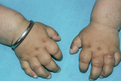 Hunter Syndrome is a psychological condition that affects people The patient's age and the seriousness of the disease determine the treatment plan
