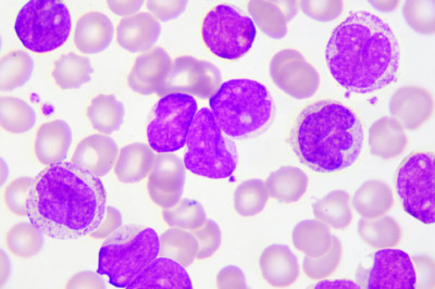 Patients will now heal faster than ever before thanks to new Chronic Myeloid Leukemia Treatment Options