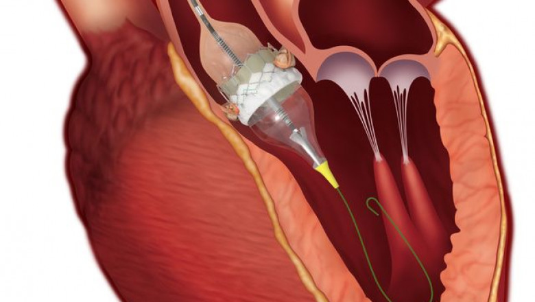 Transcatheter Heart Valve Implantation Is A Minimally-Invasive Procedure To Repair Damaged Heart Valves