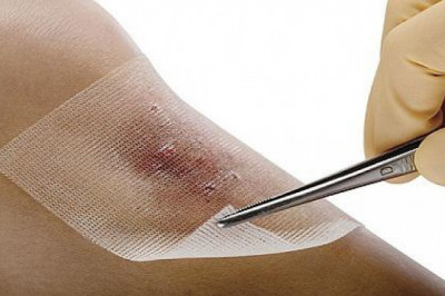 Antimicrobial wound dressing has been one of the most common treatments for a variety of skin conditions