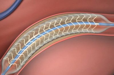 In the field of clinical innovation bioabsorbable stents are among the freshest developments