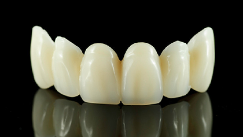 Look Out for the Best-Quality Dental Crowns Services