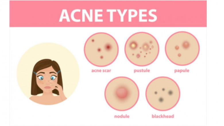 Strategies for Acne Scar Skin Care