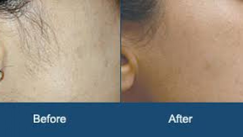 Seven advantages of laser hair removal treatment