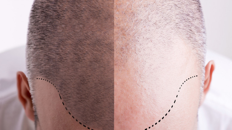 Hair Transplant Surgery Can Improve Your Love Life