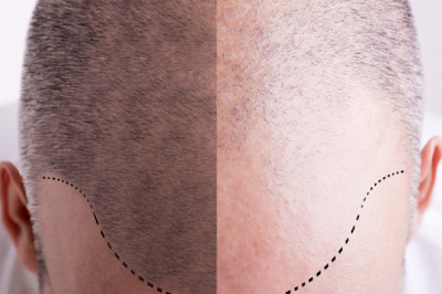 Hair Transplant Surgery Can Improve Your Love Life