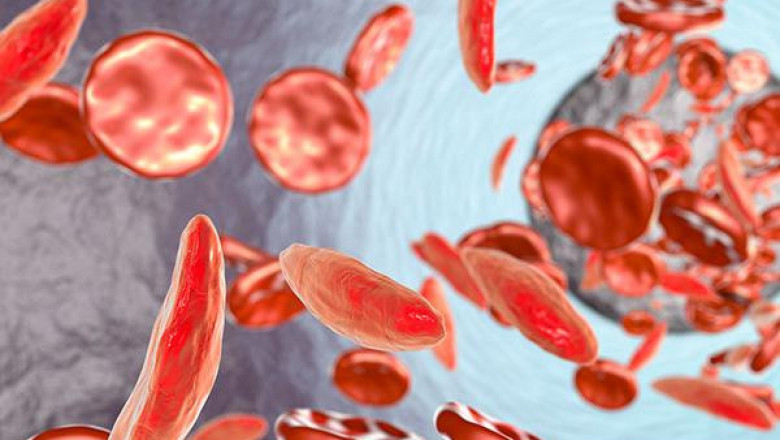 Sickle Cell Anemia Therapeutics Market Size Share Trends Forecast 2026
