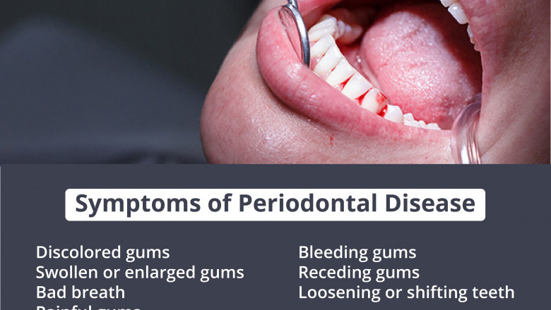 Symptoms of Periodontal Disease | Emergency Dental Service