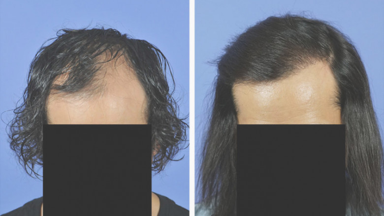 Variables to think about Just before Hair Transplantation