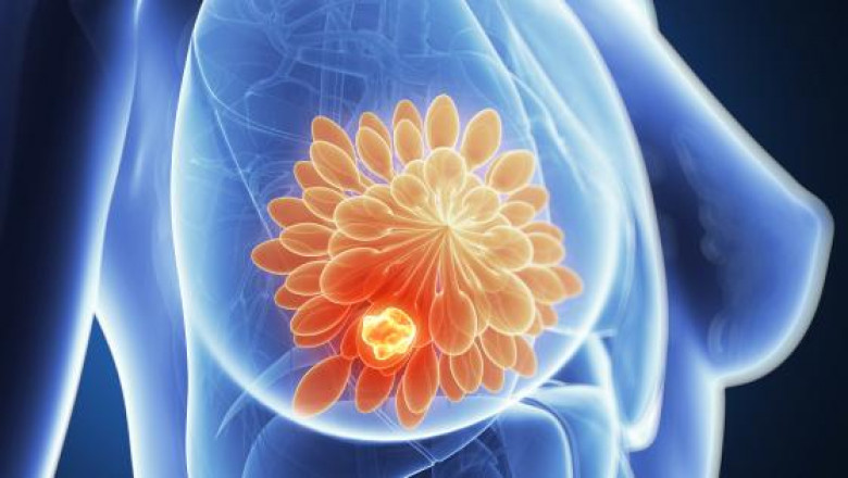 Gynecomastia | Breast Cancer Surgery in Delhi, Gurugram, Gurgaon, Haryana