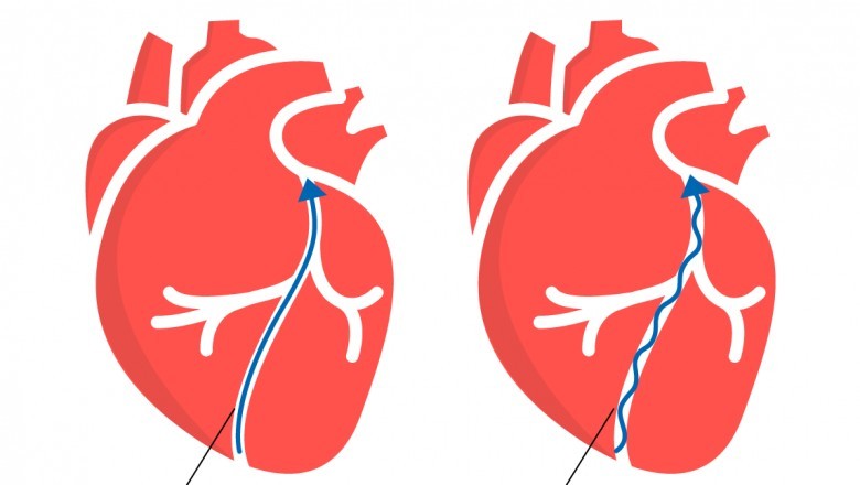 Hypertension Treatment in Ghaziabad
