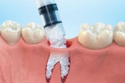 Tooth Regeneration Market To Surpass 5,980 Million Dental Procedures By 2027 - Coherent Market Insights