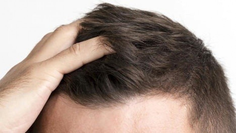 What to Expect After a Hair Transplant