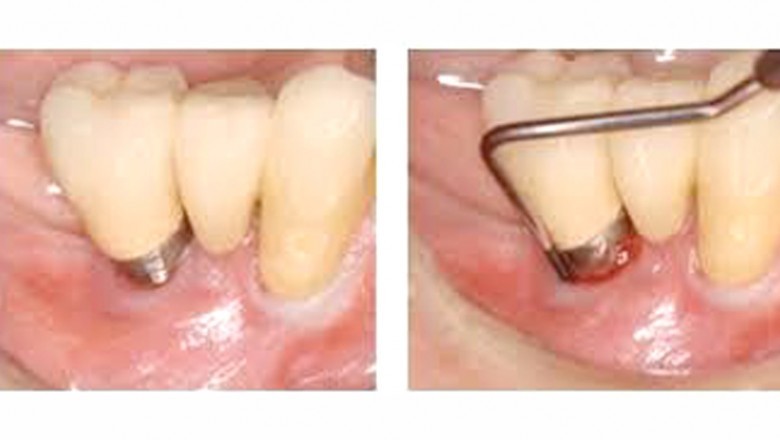 One of the most classic periodontal treatment options