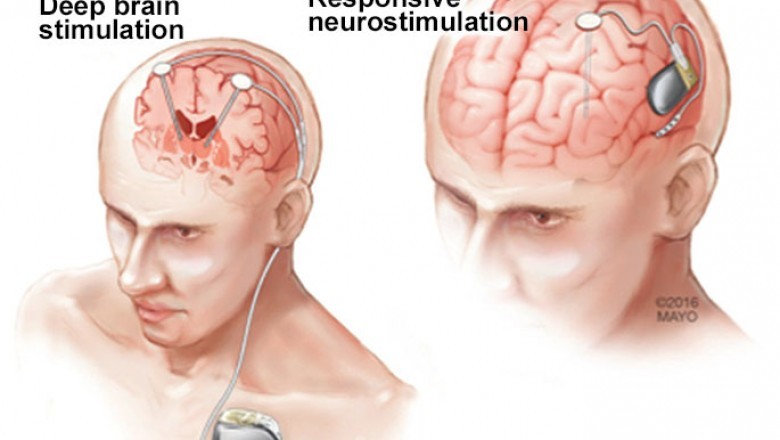 Neurostimulation Devices Market is set to witness massive growth by 2022