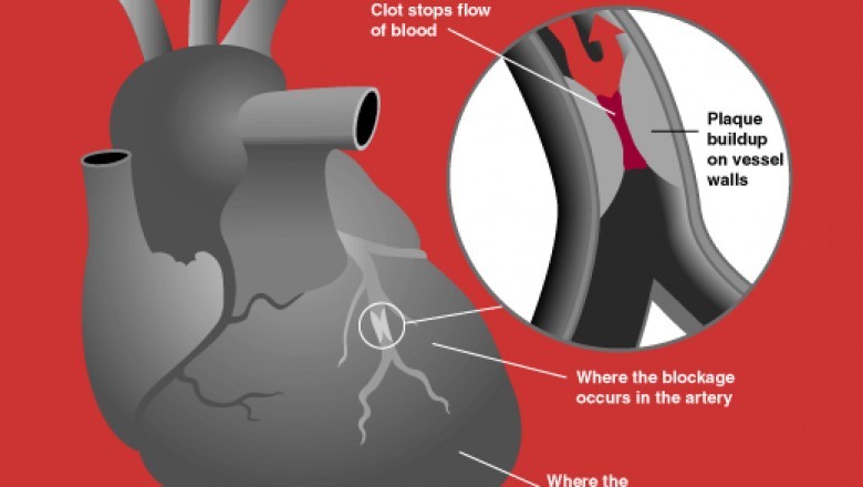 Acute Coronary Syndrome Market Forecast, Sales Revenue, Comprehensive Research Study, Demand, Growth, Segmentation and Key Companies