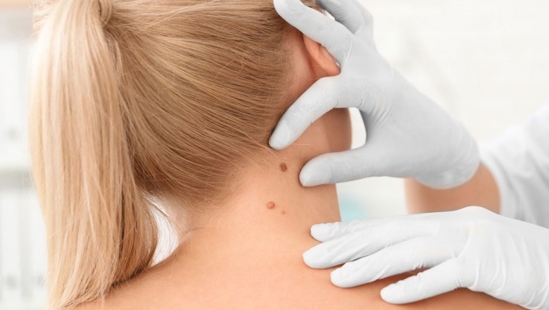 Seborrheic Keratosis Market Expected to Rise at A High CAGR, Driving Robust Sales and Revenue till 2023