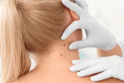 Seborrheic Keratosis Market Expected to Rise at A High CAGR, Driving Robust Sales and Revenue till 2023