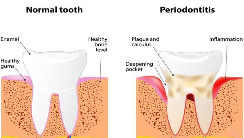 7 Benefits of Using Laser Therapy for Periodontal Disease
