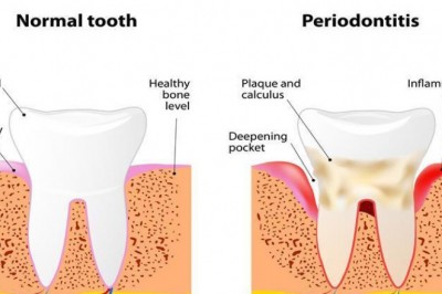 7 Benefits of Using Laser Therapy for Periodontal Disease