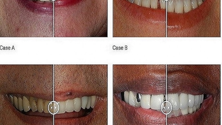 Invisalign Doctors