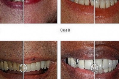 Invisalign Doctors