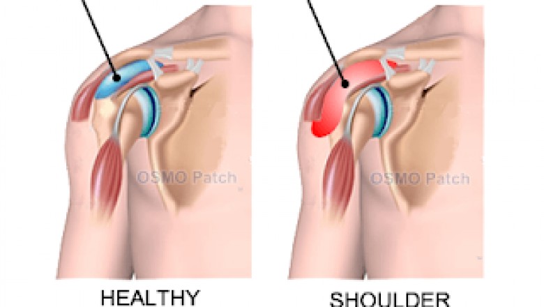 What is Shoulder Bursitis?