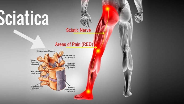 Sciatic Pain Relief MD: What Causes Sciatica Pain During Pregnancy?