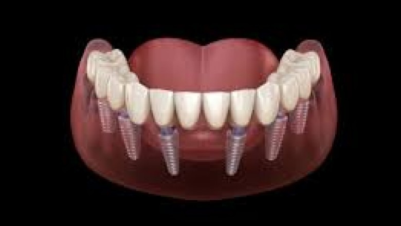 Importance and Benefits of All on 6 Dental Implants
