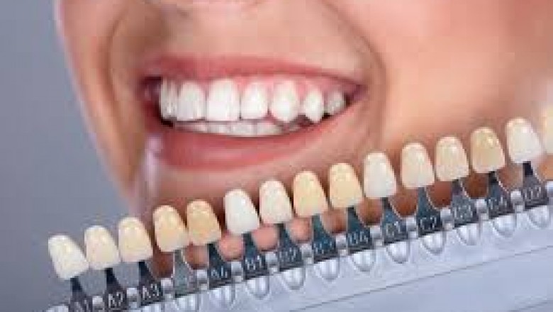 Importance of Choosing Veneers in Melbourne