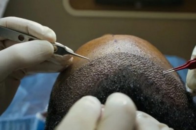 What Can Go Wrong With Hair Transplant?