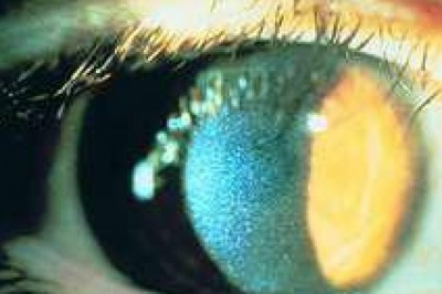 Patients with Cystinosis, a condition marked by a high accumulation of cysteine in the body, are given treatment