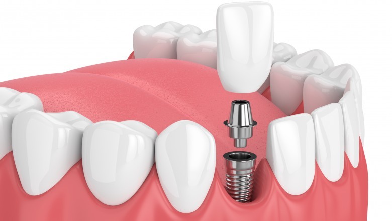 Get Best Dental Implants Treatment at Exquisite Smiles